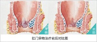 肛门口长了包是怎么回事