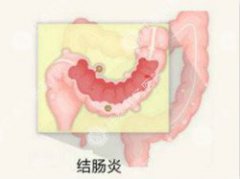 结肠炎严重吗?