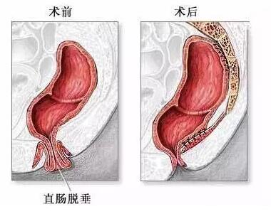肛门异物由哪些疾病引起的？